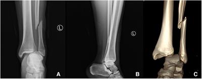 Posttraumatic checkrein deformity following isolated Lauge–Hansen pronation external rotation stage IV malleolar fracture—a case report and literature review